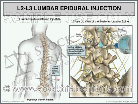 L2-L3 Epidural Injection of Lumbar Spine Trial Exhibit (Male)
