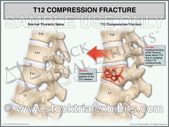 This trial exhibit depicts T12 compression fracture injury of the thoracic spine, compared to a normal thoracic spine shown in the lateral view. Clear descriptive labels of anatomy and fracture injury of the thoracic spine highlighting the injury, and contrasting it to the normal anatomy.