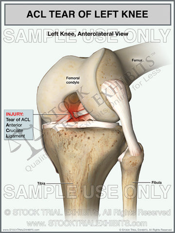ACL Tear of the Left Knee