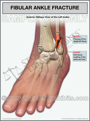 Ankle Fracture - Fibular Fracture of the Left Ankle