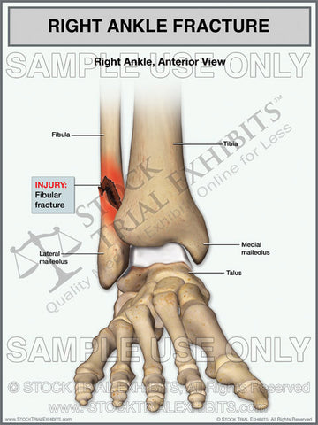 Ankle Fracture of the Right Fibula Trial Exhibit