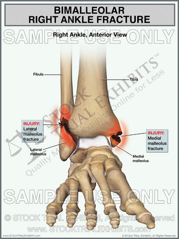 Bimalleolar Right Ankle Fracture