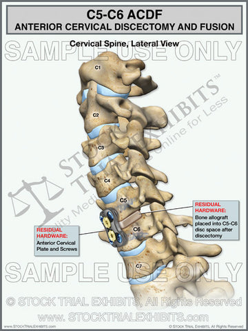 ACDF C5-C6 Anterior Cervical Discectomy and Fusion