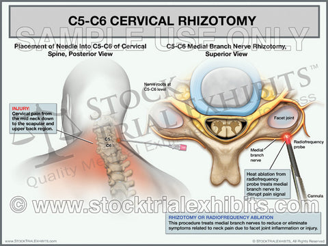 C5-C6 Cervical Rhizotomy Trial Exhibit (Male)