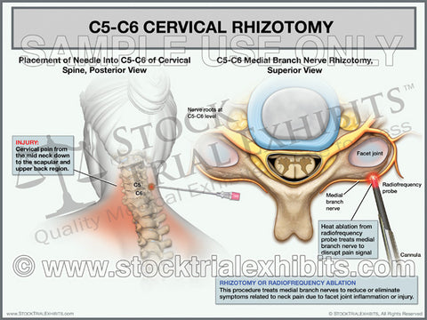 C5-C6 Cervical Rhizotomy Trial Exhibit (Female)