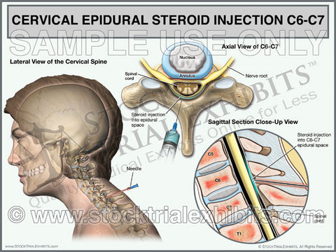 C6-C7 Cervical Epidural Steroid Injection Trial Exhibit (Female)