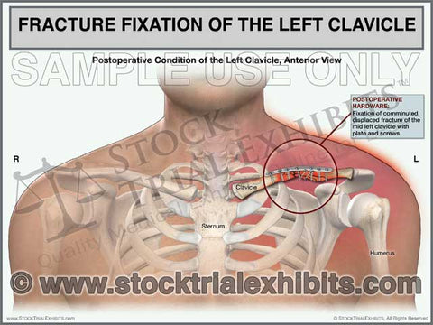 Clavicle Fracture with Fixation Left Side (Male)