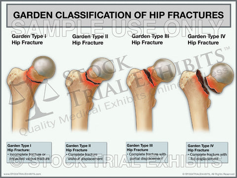 Garden Classification of Hip Fractures Trial Exhibit