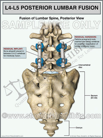 L4-L5 Lumbar Spine Fusion Posterior View