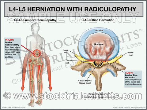 L4-L5 Herniation with Radiculopathy - Female