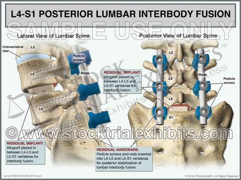 L4-S1 Posterior Lumbar Interbody Fusion (PLIF)