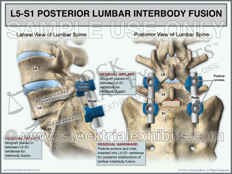 L5-S1 Posterior Lumbar Interbody Fusion (PLIF)