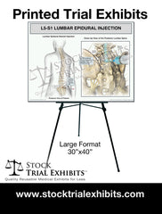 L4-L5 Epidural Injection of Lumbar Spine Trial Exhibit (Female) large format printed trial exhibit
