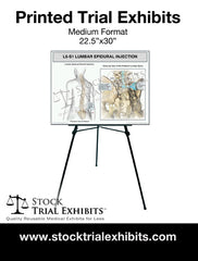 L4-L5 Epidural Injection of Lumbar Spine Trial Exhibit (Female) printed trial exhibit