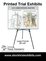 L5-S1 Epidural Injection of Lumbar Spine Trial Exhibit (Male)