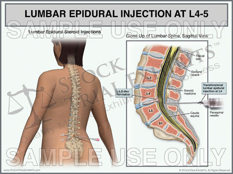 Lumbar Epidural Injection of L4-5 Trial Exhibit (Female)