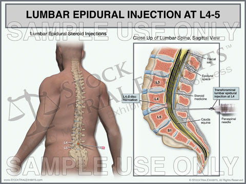 Lumbar Epidural Injection of L4-5 Trial Exhibit (Male)