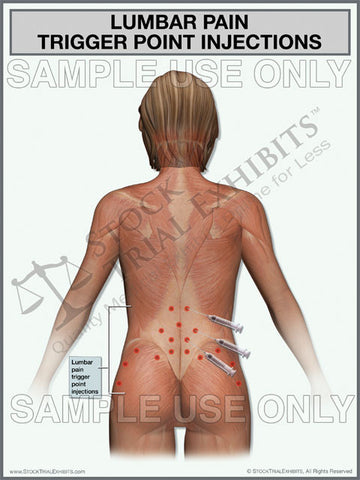 Lumbar Pain Trigger Point Injections Exhibit (Female)