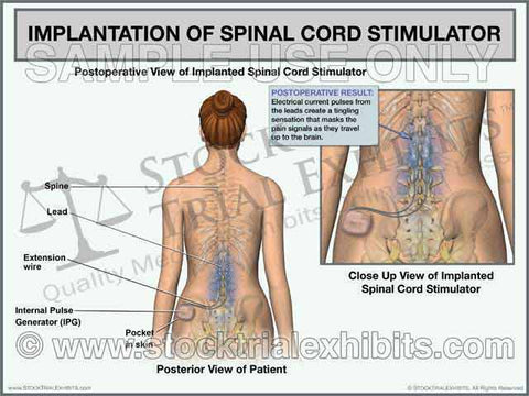Lumbar Spinal Cord Stimulator Implantation Trial Exhibit (Female)