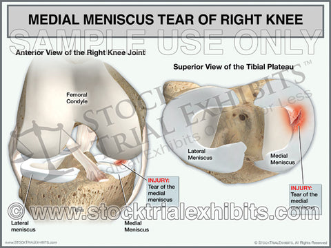 Medial Meniscus Tear of the Right Knee