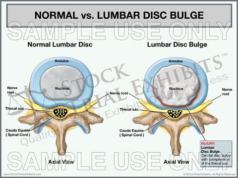 Normal Lumbar Disc vs. Lumbar Disc Bulge Trial Exhibit (Axial View)
