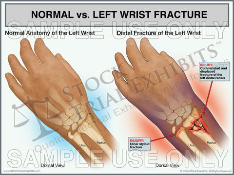 Normal Anatomy vs. Left Wrist Fracture Trial Exhibit