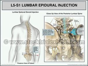 L5-S1_lumbar_epidural_injection