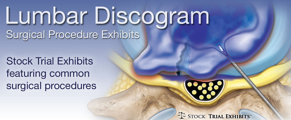 Stock trial exhibits Lumbar Discogram