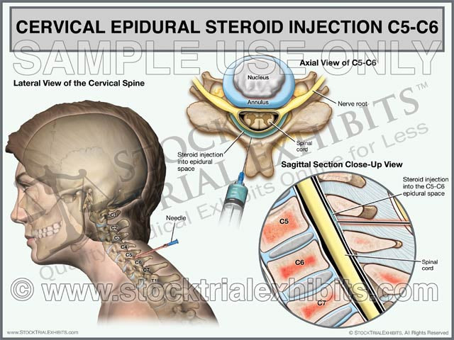 This trial exhibit depicts a cervical epidural steroid injection on C5-C6 of a female patient in multiple views. An epidural steroid injection is usually performed to relieve pain associated with inflammation from an injury to the cervical spine. A cervical epidural injection is often done to provide pain relief or for pain management after an injury, such as a disc bulge, herniation or cervical radiculopathy. C5-C6 Cervical Epidural Steroid Injection Trial Exhibit