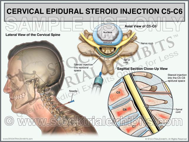 This trial exhibit depicts a cervical epidural steroid injection on C5-C6 of a male patient in multiple views. An epidural steroid injection is usually performed to relieve pain associated with inflammation from an injury to the cervical spine. A cervical epidural injection is often done to provide pain relief or for pain management after an injury. C5-C6 Cervical Epidural Steroid Injection Trial Exhibit
