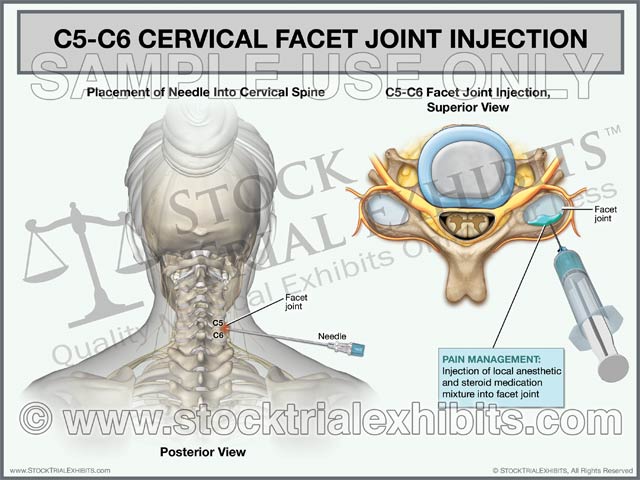 C5-C6 Cervical Facet Joint Injection Trial Exhibit (Female) – Stock ...