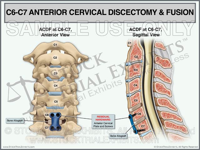 C6-C7 ACDF Anterior Cervical Discectomy and Fusion – Stock Trial Exhibits