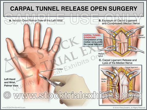 Carpal Tunnel Release, Open Surgery of the Left Wrist