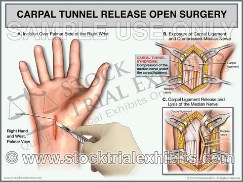 Carpal Tunnel Release, Open Surgery of the Right Wrist