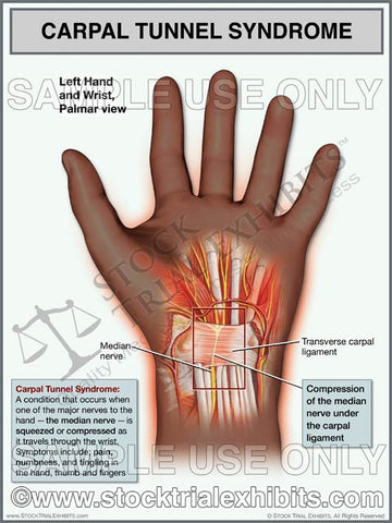 Carpal Tunnel Syndrome, Left Wrist (African American)