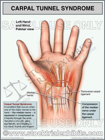 Carpal Tunnel Syndrome, Left Wrist