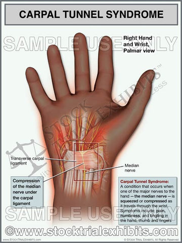Carpal Tunnel Syndrome, Right Wrist (African American)