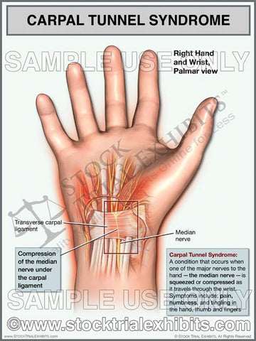 Carpal Tunnel Syndrome, Right Wrist