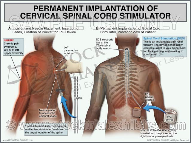 Diagram, medical illustrations of permanent implantation of spinal cord stimulator of the cervical spine with anatomical labels. Medically accurate trial exhibit for demand letters, mediation or trial presentation.