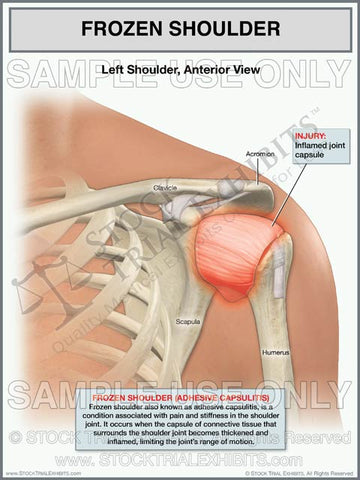 Frozen Left Shoulder (adhesive capsulitis)