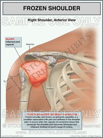 Frozen Right Shoulder (adhesive capsulitis)