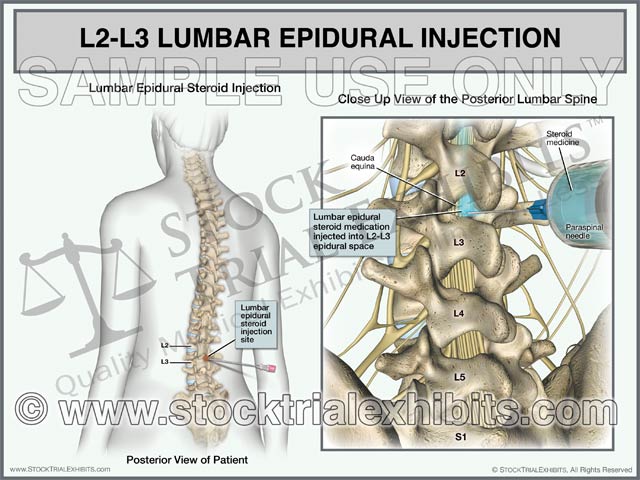 This medical exhibit depicts an L2-L3 lumbar epidural steroid injection on a female patient for pain management treatment of L2-L3 lumbar spine injury. The exhibit shows a transparent female figure orientation view of injection site location on the left, with a close up posterior view of the epidural steroid injection procedure with lumbar spine anatomy in detail on the right, with descriptive labels. L2-L3 Lumbar Injection Trial Exhibit