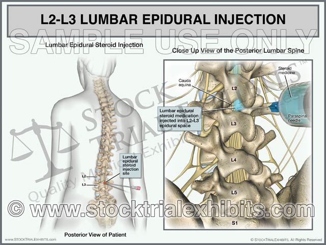Left Bottom Injection L2-L3 Epidural Injection of Lumbar Spine Trial Exhibit (Female) – Stock ...