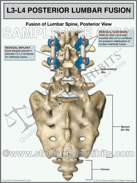 L3-L4 Lumbar Spine Fusion Posterior View – Stock Trial Exhibits