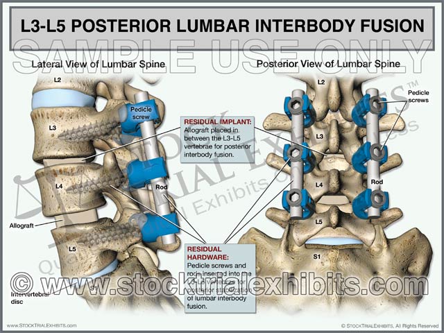 L3-L5 Posterior Lumbar Interbody Fusion (PLIF) – Stock Trial Exhibits
