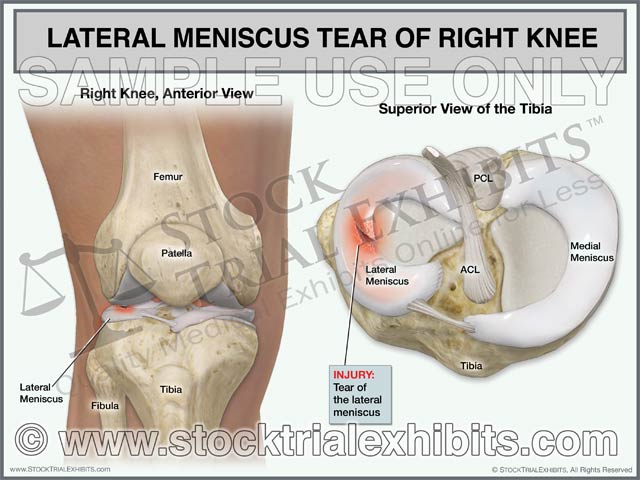 This trial exhibit depicts a right knee with a lateral meniscus tear. Anterior view of right knee is shown for orientation of anatomy and location of injury. A superior view of the tibia is also shown, enlarged view that graphically depicts the lateral meniscus tear. Both views of the knee are shown with descriptive labels of knee anatomy and lateral meniscus injury.