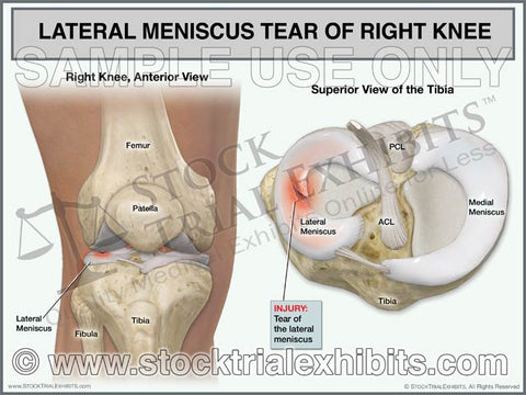 Lateral Meniscus Tear of Right Knee
