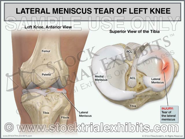 This trial exhibit depicts a left knee with a lateral meniscus tear. Anterior view of left knee is shown for orientation of anatomy and location of injury. A superior view of the tibia is also shown, enlarged view that graphically depicts the lateral meniscus tear. Both views of the knee are shown with descriptive labels of knee anatomy and lateral meniscus injury.