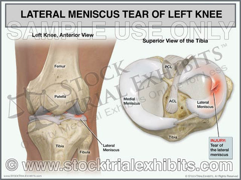Lateral Meniscus Tear of Left Knee