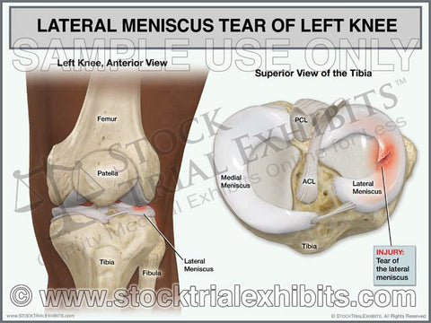 Lateral Meniscus Tear of Left Knee (African American)